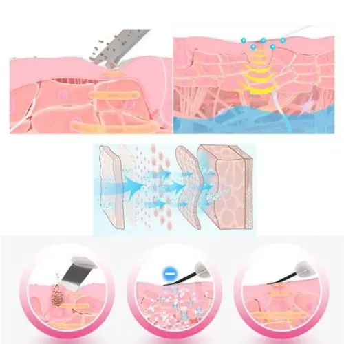 Σπάτουλα προσώπου υπερήχων - LMC Beauty Ultrasonic » Murzl H30dbf348a62c49ff978d1bbd23e3b4aav-500x500
